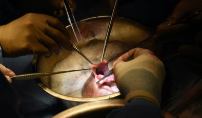 Are pig heart transplants a reality? Successful surgery shows it’s possible
